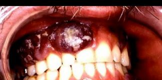 Krokodil in Colombia